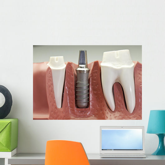 Dental Implant Model Wall Mural