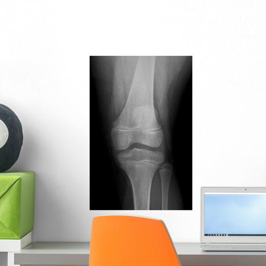 Ap X-ray Injured Knee