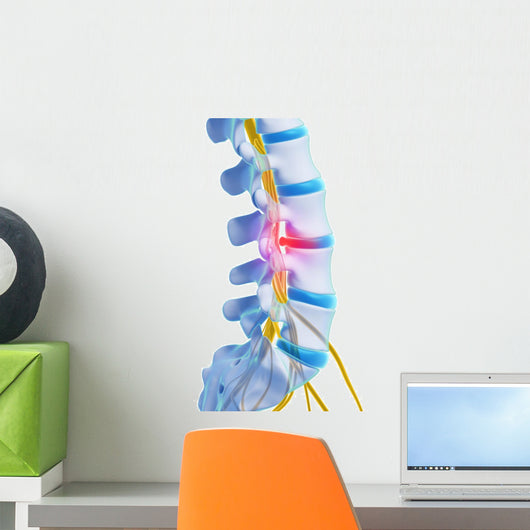 3d Rendered Illustration - Herniated Disk Wall Decal