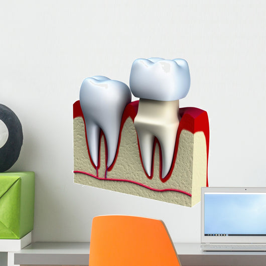 Dental crown installation process, isolated on white Wall Decal