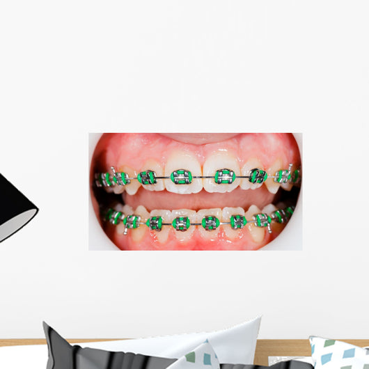 Braces on teeth Wall Mural