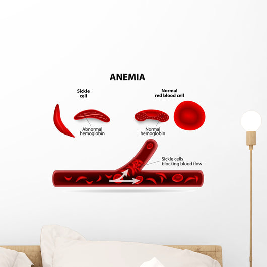 anemia diagram Wall Mural