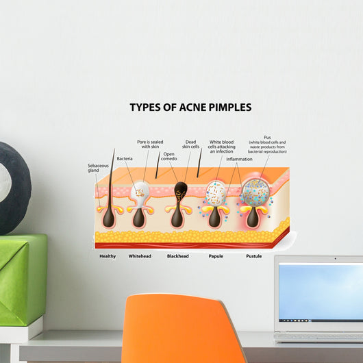 acne pimple types Wall Decal