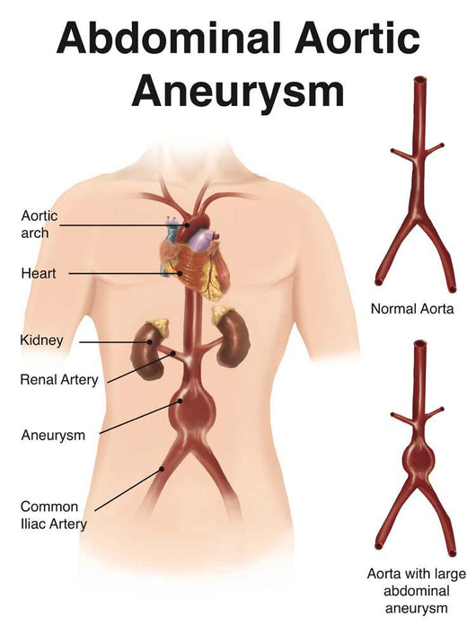 Artist Depiction Abdominal Aortic Wall Decal Design 1