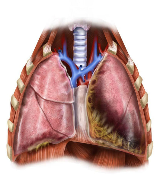 Artist Depiction Mesothelioma Lungs Wall Decal