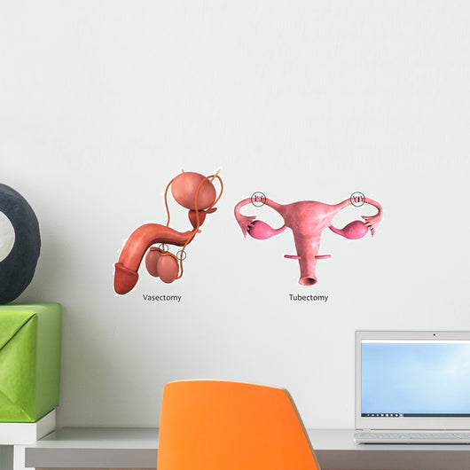 Biomedical Illustration Vasectomy and Wall Decal