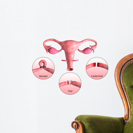 Biomedical Illustration Tubectomy Wall Decal Design 2