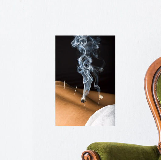 Patient Receiving Acupuncture Treatment Wall Decal