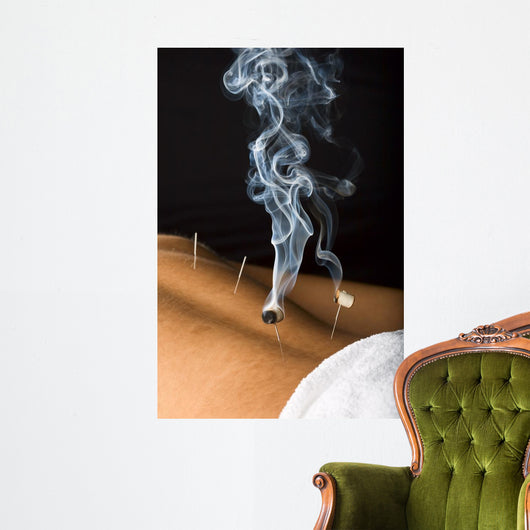 Patient Receiving Acupuncture Treatment Wall Decal