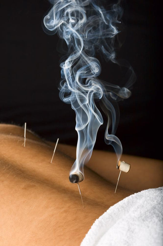 Patient Receiving Acupuncture Treatment Wall Decal
