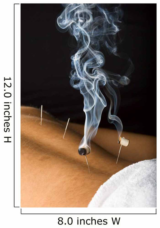 Patient Receiving Acupuncture Treatment Wall Decal
