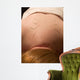 acupuncture Wall Mural