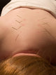 acupuncture Wall Mural