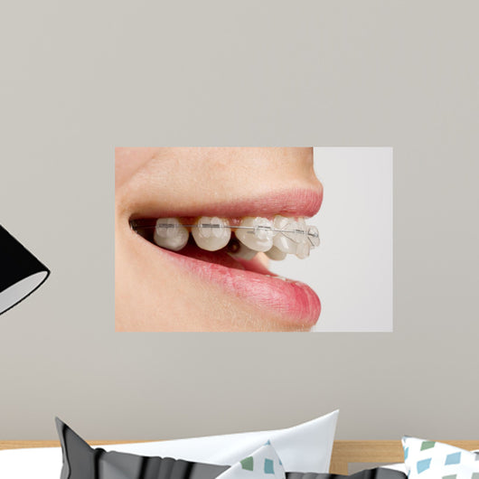 Braces on teeth Wall Mural
