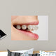 Braces on teeth Wall Mural