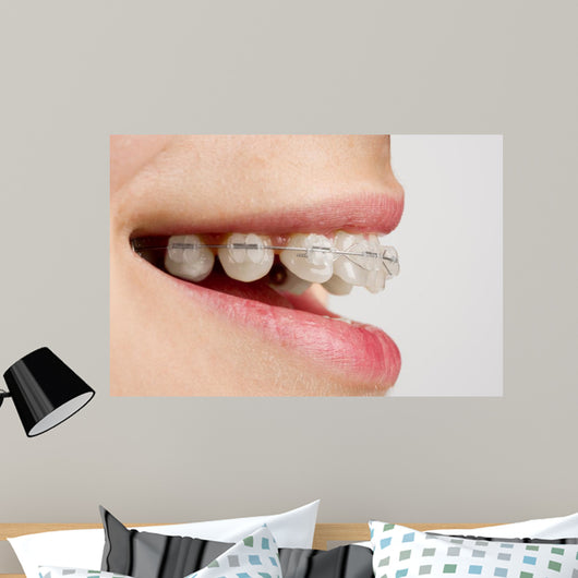 Braces on teeth Wall Mural