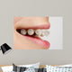 Braces on teeth Wall Mural