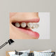 Braces on teeth Wall Mural