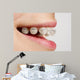 Braces on teeth Wall Mural