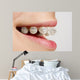 Braces on teeth Wall Mural