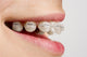 Braces on teeth Wall Mural