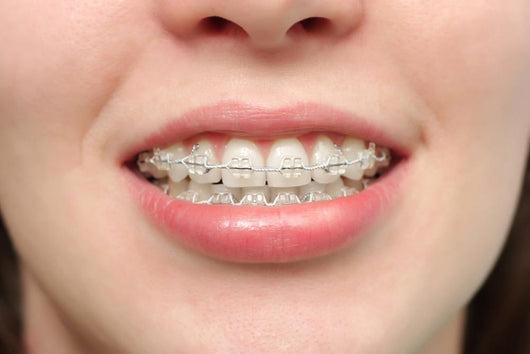 Girl Smiles with Braces Wall Decal
