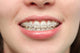 Girl Smiles with Braces Wall Decal