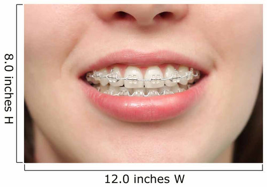 Girl Smiles with Braces Wall Decal