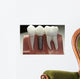 Capped Dental Implant Model Wall Mural