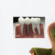 Capped Dental Implant Model Wall Mural