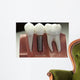 Capped Dental Implant Model Wall Mural