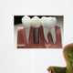 Capped Dental Implant Model Wall Mural