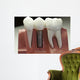 Capped Dental Implant Model Wall Mural
