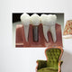 Capped Dental Implant Model Wall Mural