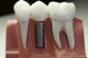 Capped Dental Implant Model Wall Mural