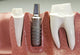 Dental Implant Model Wall Mural