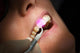 Dental laser dental gums Wall Mural