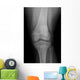 Ap X-ray Injured Knee