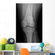 Ap X-ray Injured Knee
