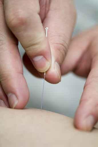 treatment by acupuncture Wall Mural