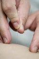 treatment by acupuncture Wall Mural