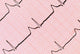 Ecg Graph