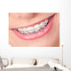 Mouth with Braces and