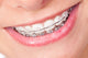 Mouth with Braces and