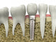 Dental Implant Wall Decal