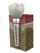 Dental implant Wall Decal