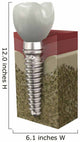 Dental Implant Wall Decal