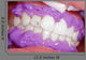 Cosmetic dental cleaning Wall Mural