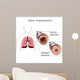 asthma Wall Mural