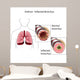 asthma Wall Mural